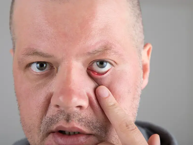 PODCAST: Blepharitis