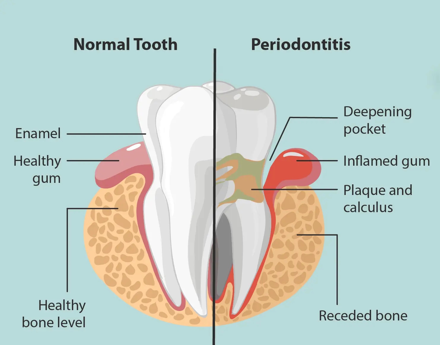 Depiction_of_a_Periodontitis_patient.png