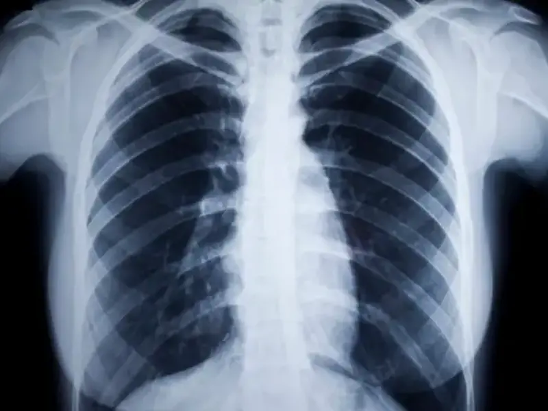 Sarcoidosis - clinical fact sheet and MCQ 