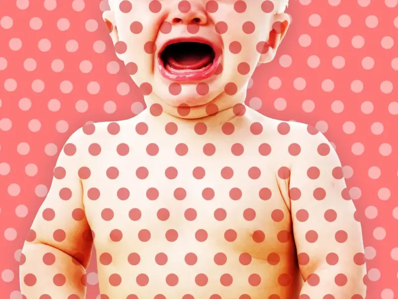 Measles: Rare, but Still There