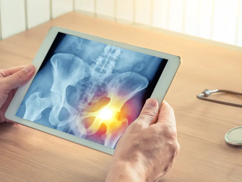 OA of the hip: The HIT Trial