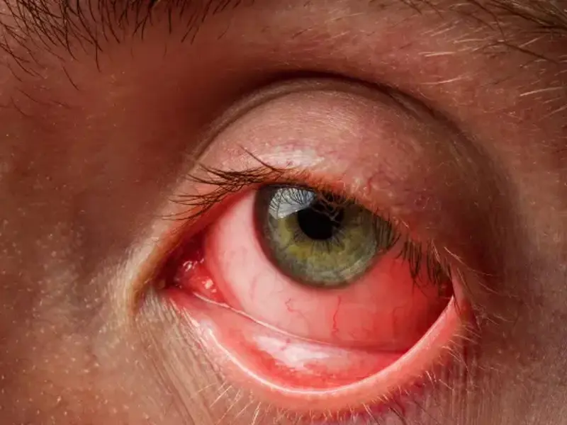 Conjunctivitis - clinical fact sheet and MCQ 