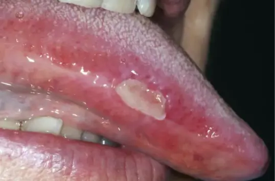 oralmucosalulcersimage3_png.png